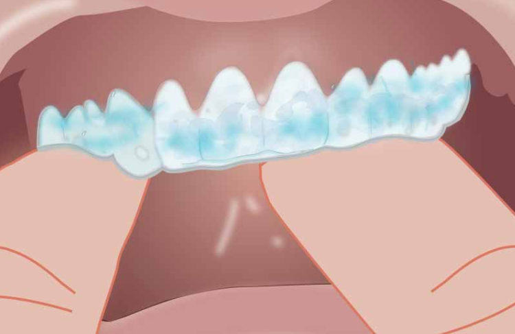 image représentant une étape d'un blanchiment des dents, dentisterie esthétique