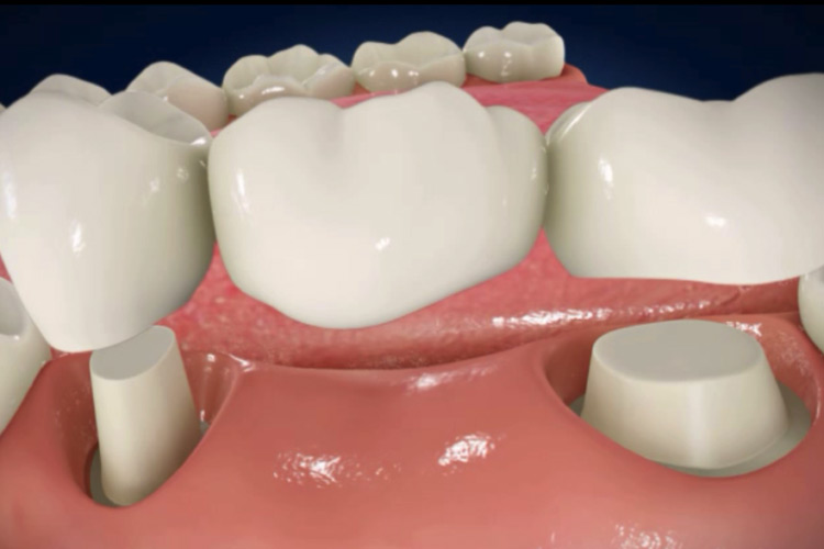 représentation 3d d'un bridge dentaire, clinique dentaire newport pantin