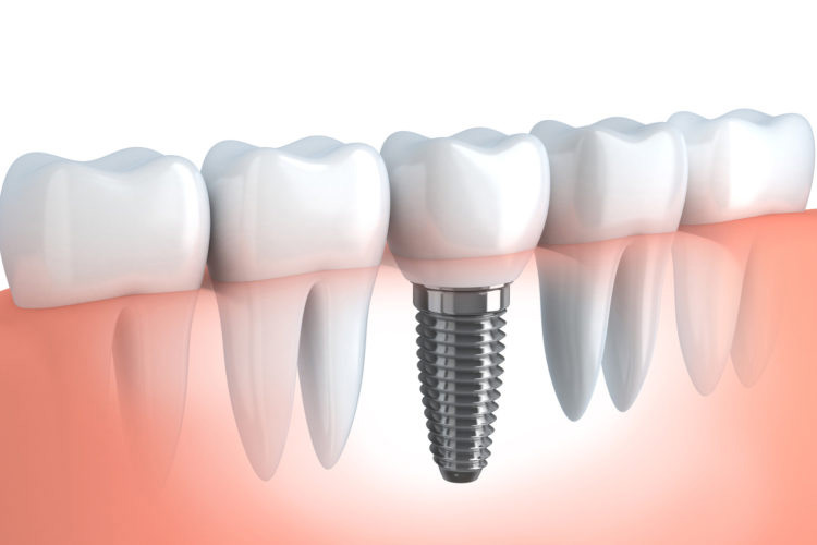 image représentant un implant dentaire installé , clinique dentaire newport pantin