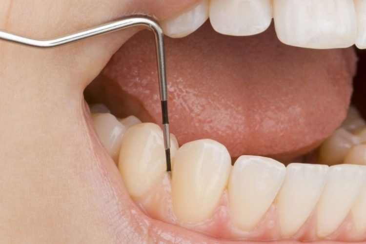 photo d'un outil de dentiste, parondontologie