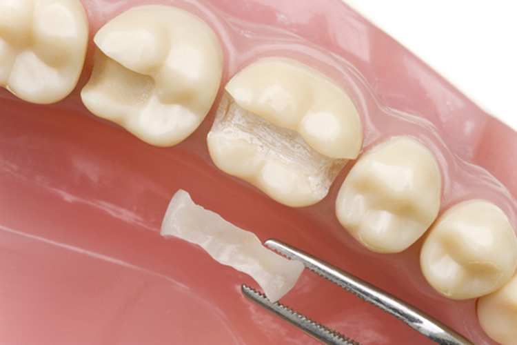 photo de dents pour présenter des soins conservateurs, clinique dentaire newport pantin